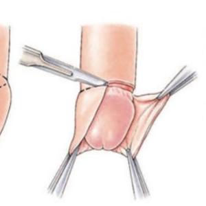 Vorhautbeschneidung bei Mann und Frau