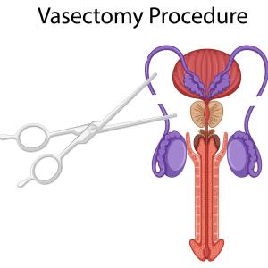 MÄNNER nach Vasektomie