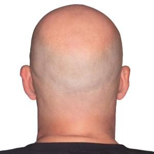 Glatzenträger & Glatzenliebhaber 👨‍🦲